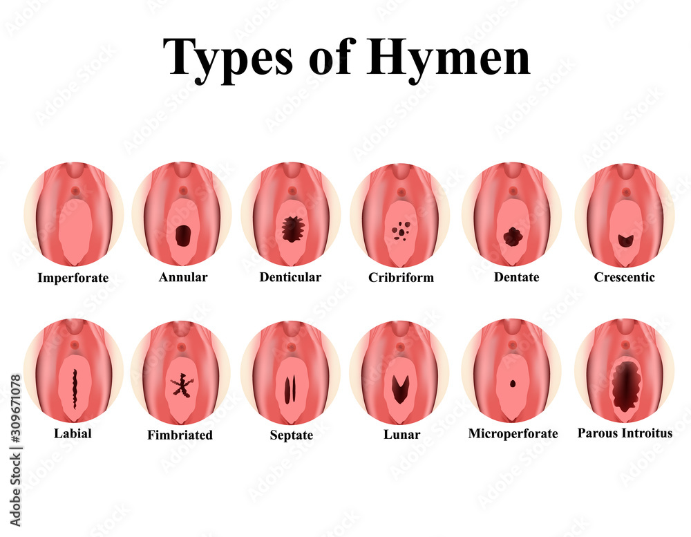 Sichtbar Hymen? Kann man das Jungfernhäutchen sehen? Ein umfassender Überblick über Anatomie, Mythen und Realität