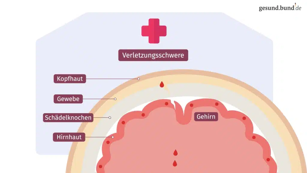 Die erschütternde Wahrheit: Gehirnerschütterung, Autofahren und die Frage der Fahreignung nach einem schweren Schädel-Hirn-Trauma